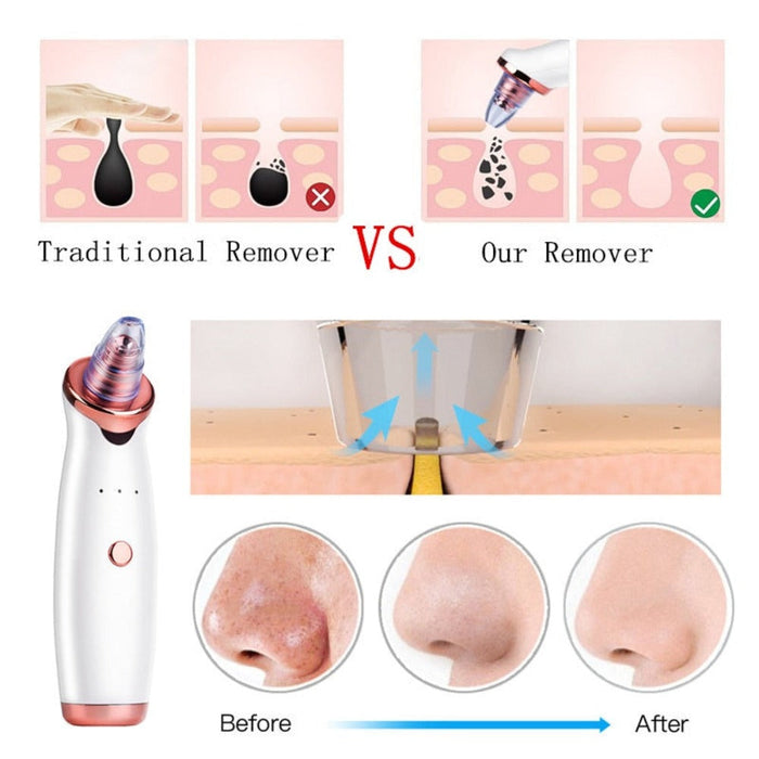 Electric Vacuum Blackhead Remover Device: white, silver handheld pore vacuum / blackhead remover device, modern cosmetic beau